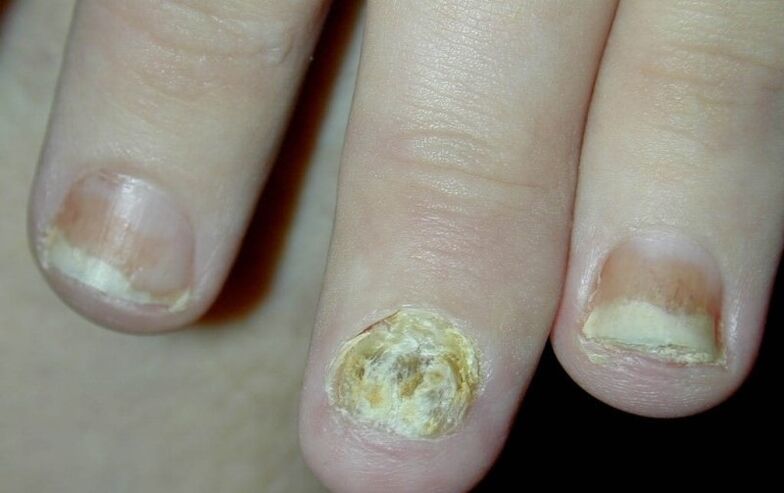 psoriasis of the nails of the hand