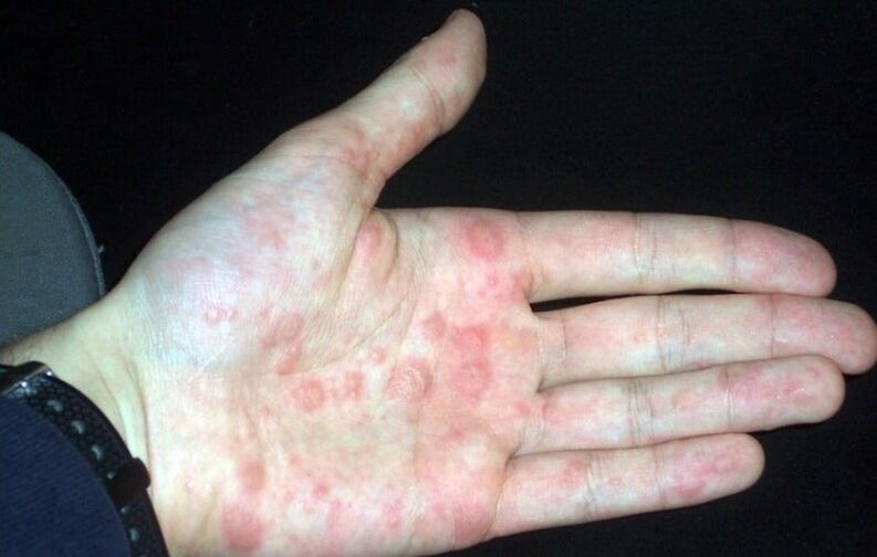 psoriasis plaques on hands