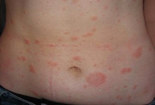 How to treat psoriasis in the body