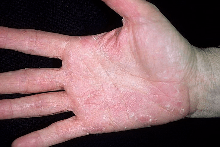 psoriasis of the palms and under it