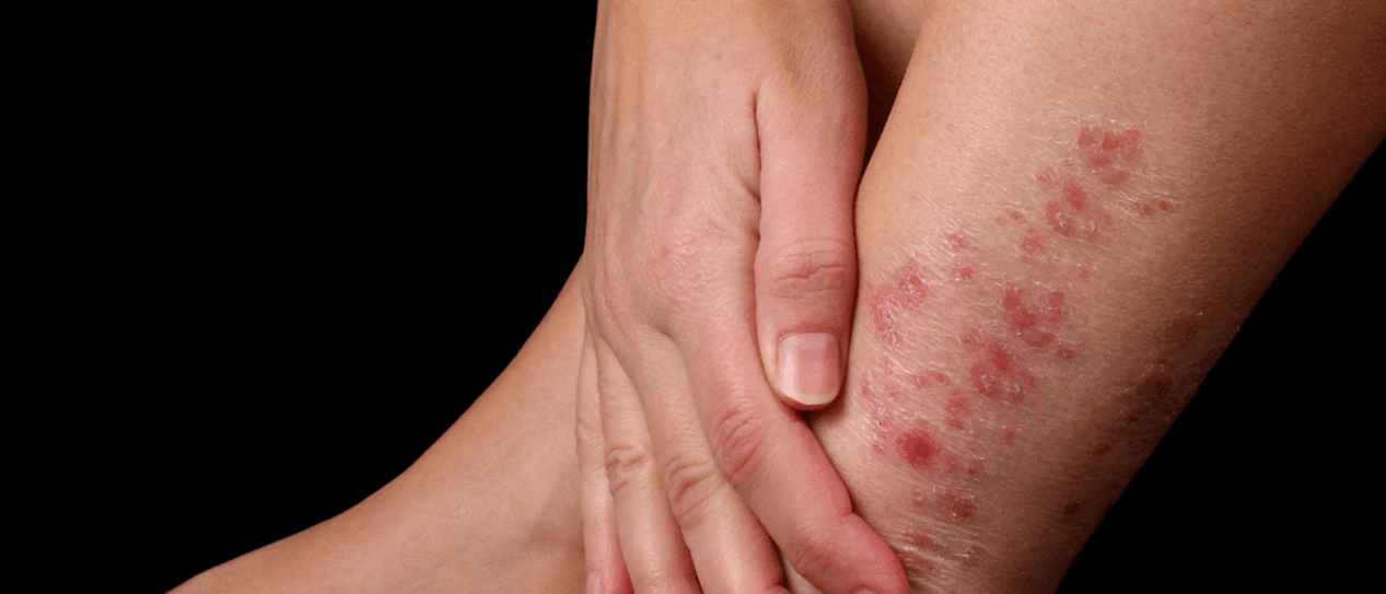 Psoriasis plaques on the skin of the foot