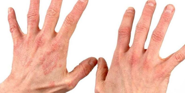 psoriasis on hands how to treat folk remedies