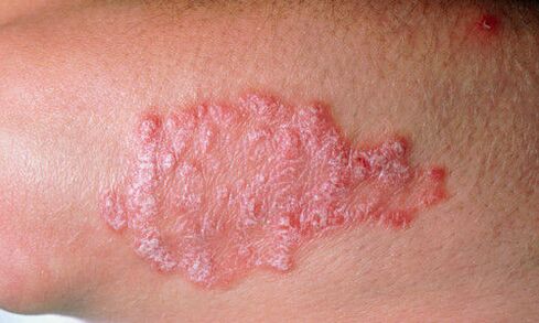 psoriasis picture on skin 2