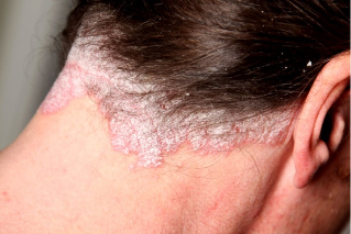 diapers psoriasis of the scalp