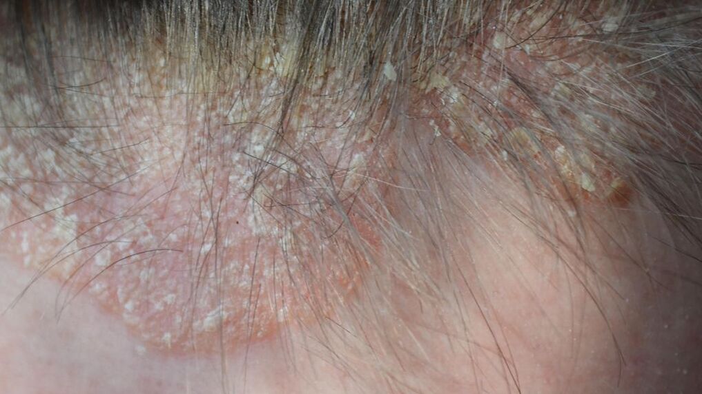 psoriasis picture on the head 4