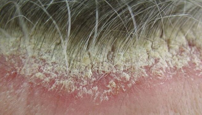 psoriasis picture on the head 5