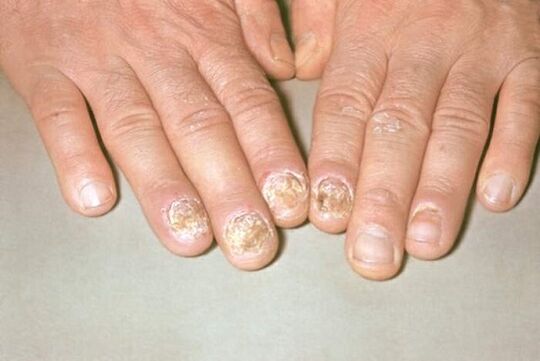 Photo of nails with psoriasis 1