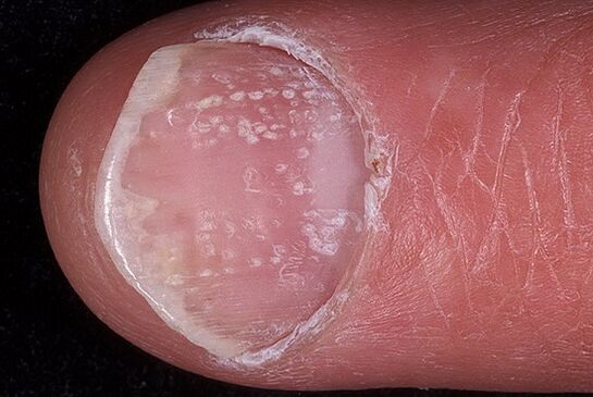 Photo of nails with psoriasis 2