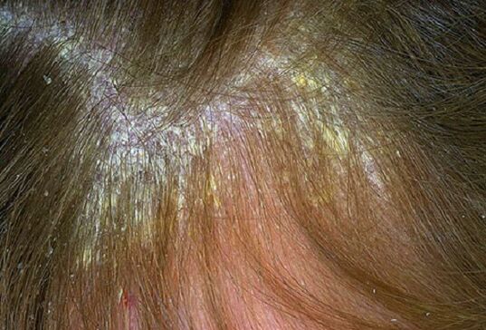 psoriasis picture on the head 1