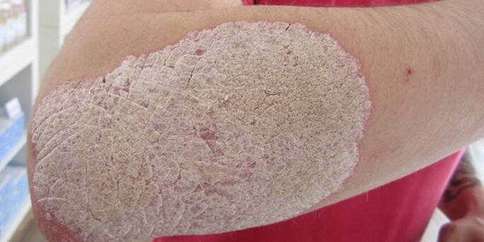 picture of psoriasis on the elbows