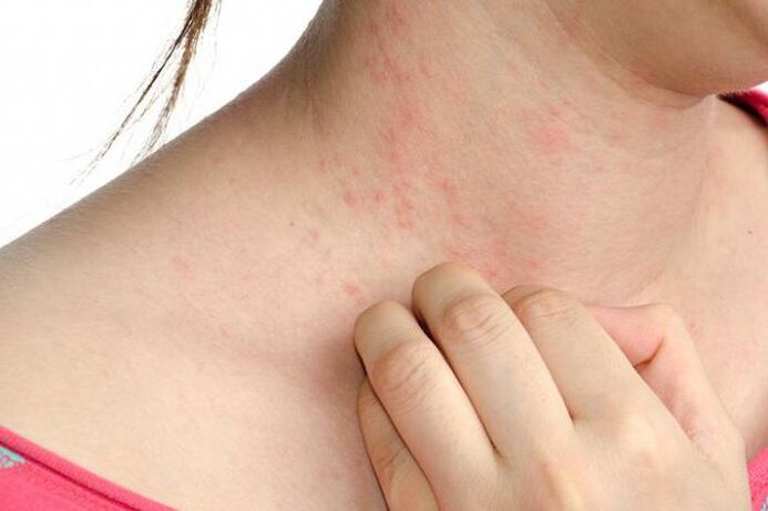 Aggravation of psoriasis is manifested by skin redness and severe itching