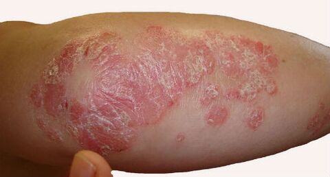 Scaly, voluminous plaques on the elbow during exacerbation of psoriasis