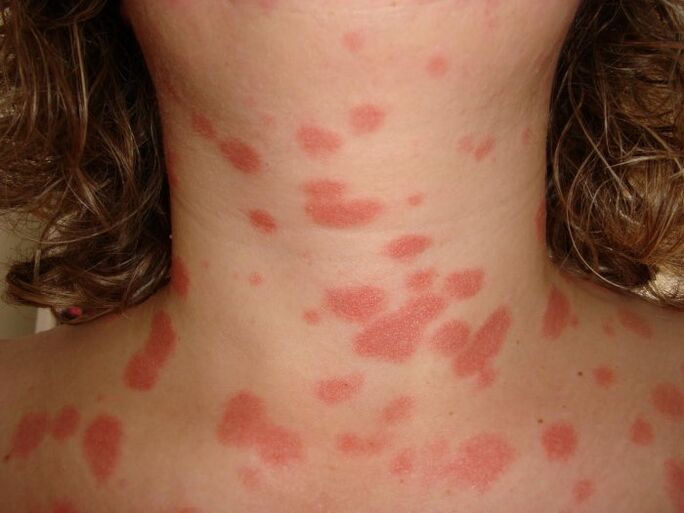 Psoriatic plaques on the skin