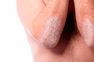Psoriasis of the elbows