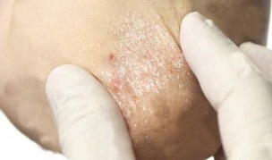 treatment of psoriasis in the mitigation phase