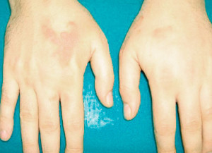 Localization of the disease in the hands