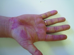Pustules of the palms and plants