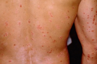 psoriasis early stages